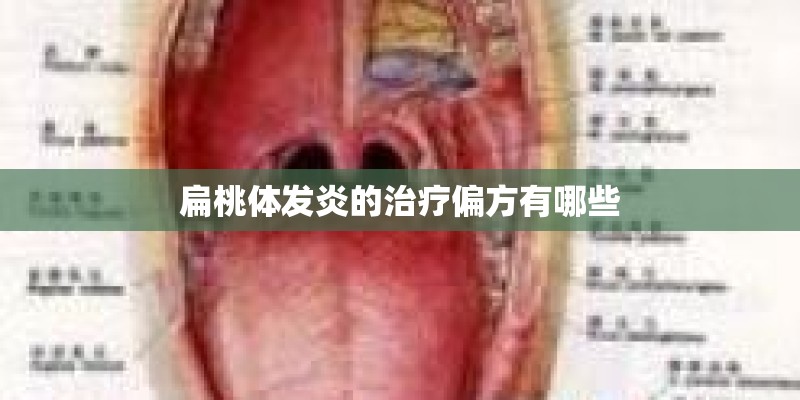 扁桃体发炎的治疗偏方有哪些