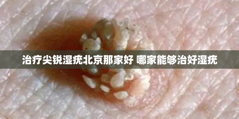 治疗尖锐湿疣北京那家好 哪家能够治好湿疣
