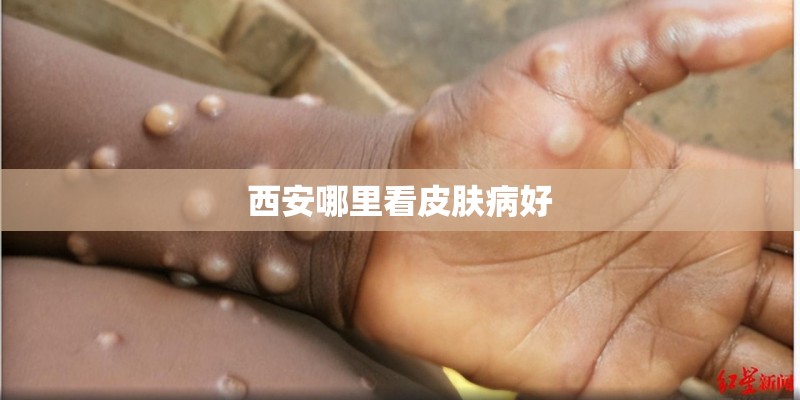 西安哪里看皮肤病好