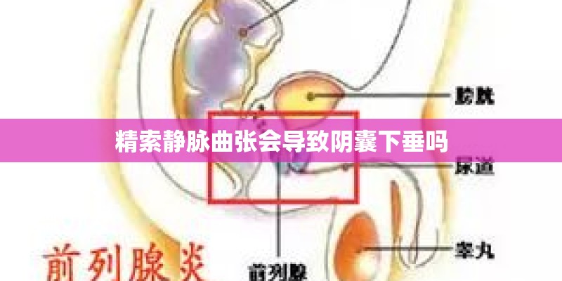 精索静脉曲张会导致阴囊下垂吗