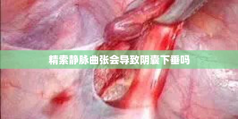 精索静脉曲张会导致阴囊下垂吗