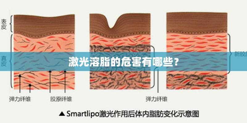 激光溶脂的危害有哪些？